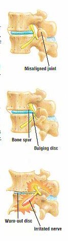 stages of spine degeneration diagram